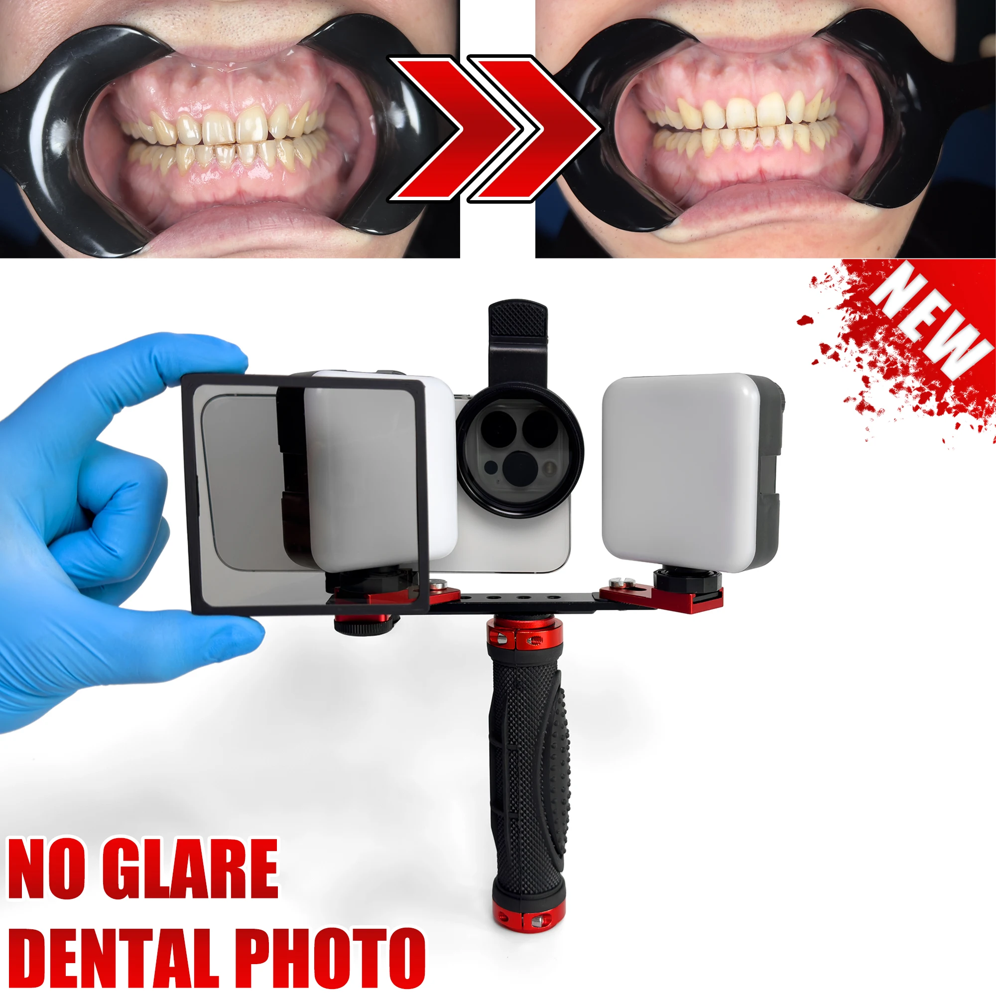 No Reflections Dental Photography Light. No Glare CPL Polarized Macro Photos Dental Treatment. Phone Photo Light Dentist
No Reflections Dental Photography Light. No Glare CPL Polarized Macro Photos Dental Treatment. Phone Photo Light Dentist