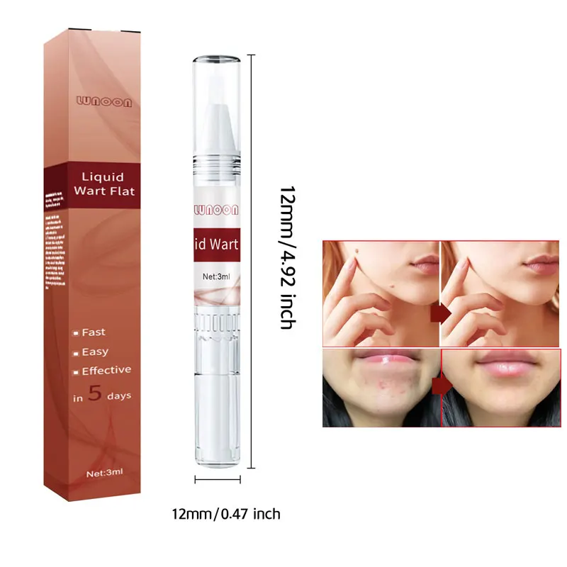 3ml Moles Pen For All Skin Types Callus Gram Warts Foot Remover Liquid Genital Wart Removal Treatment Pen Skin Beauty
3ml Moles Pen For All Skin Types Callus Gram Warts Foot Remover Liquid Genital Wart Removal Treatment Pen Skin Beauty
