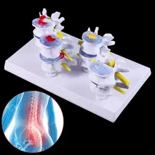 Learning-Tool Presentation-Model Spine Medical Teaching Lesion Human Lumbar 1set