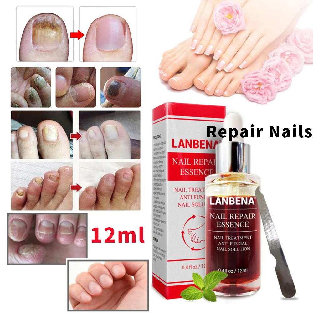 

LANBENA Fungal Nail Repair Essence Serum Care Treatment Foot Nail Fungus Removal Gel Anti Infection Paronychia Onychomycosis