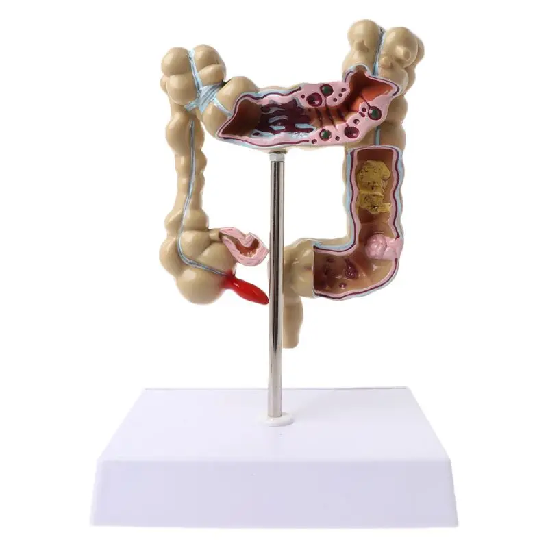 Human Colorectal Lesion Model Pathological Anatomy Colon Diseases Intestine Teaching Learning Tool
Human Colorectal Lesion Model Pathological Anatomy Colon Diseases Intestine Teaching Learning Tool