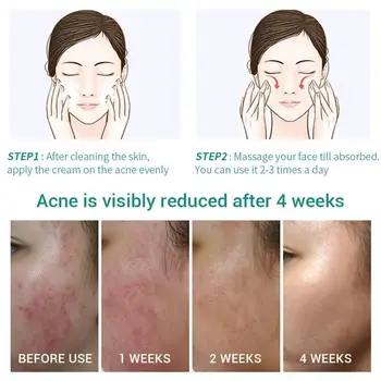 LANBENA Skin Care Gel For Acne Treatment Oil Control Scar Removal Pores Spot Pimple Shrink Q6X4
LANBENA Skin Care Gel For Acne Treatment Oil Control Scar Removal Pores Spot Pimple Shrink Q6X4