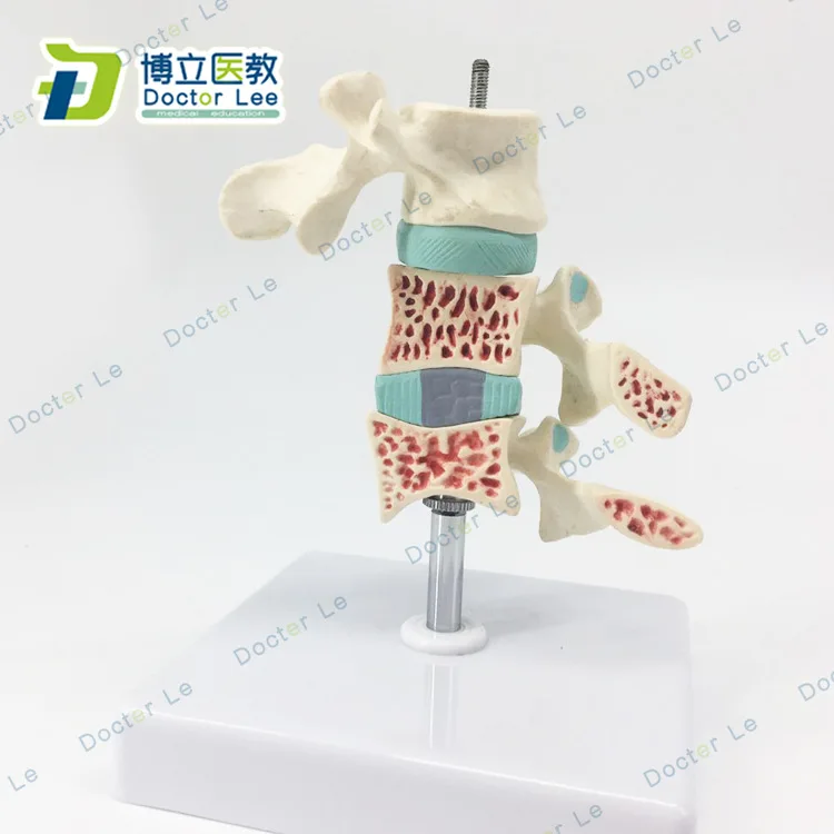 PVC Human Osteoporosis Model Intervertebral Disc Human Lumbar Anatomy Model Orthopedic Pain Department Model
PVC Human Osteoporosis Model Intervertebral Disc Human Lumbar Anatomy Model Orthopedic Pain Department Model