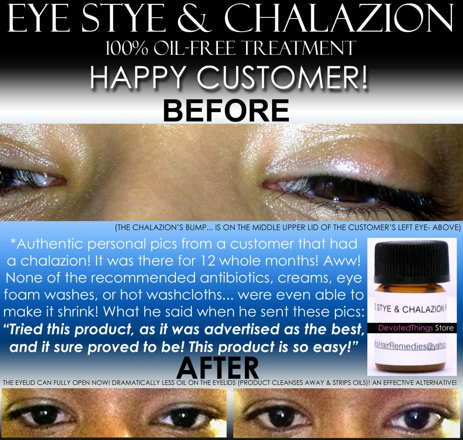 Home Eye Stye Treatment Chalazion Treatment Eyelid Infection Remedy 
Home Eye Stye Treatment Chalazion Treatment Eyelid Infection Remedy