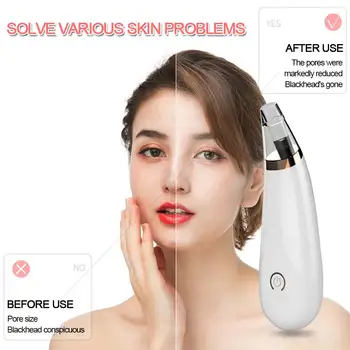 Electric Facial Pore Blackhead Vacuum Suction Remove Machine with 3 Probes Remove Dead Skin Facial Care Tools Battery
