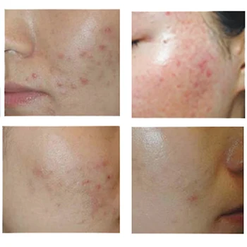 Hot Bioaqua 30g Anti Acne Cream Oil Control Shrink Pore Acnes Scar Remove Face Care CNT 66
Hot Bioaqua 30g Anti Acne Cream Oil Control Shrink Pore Acnes Scar Remove Face Care CNT 66