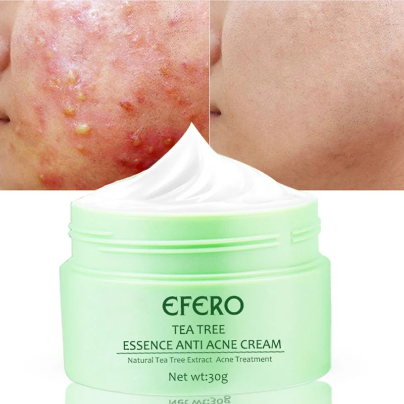 30g Tea Tree Essence Acne Treatment Cream Nourishing Skin Oil-Control Remove Acne Anti-acne Cream Skin Treatment
30g Tea Tree Essence Acne Treatment Cream Nourishing Skin Oil-Control Remove Acne Anti-acne Cream Skin Treatment