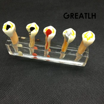 Dental 5 Stage Endodontic Treatment Model Dental Study Teach Teeth Model
Dental 5 Stage Endodontic Treatment Model Dental Study Teach Teeth Model