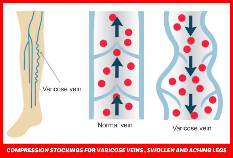 Varcoh Compression Stockings for Varicose Veins , Swollen And Aching legs.