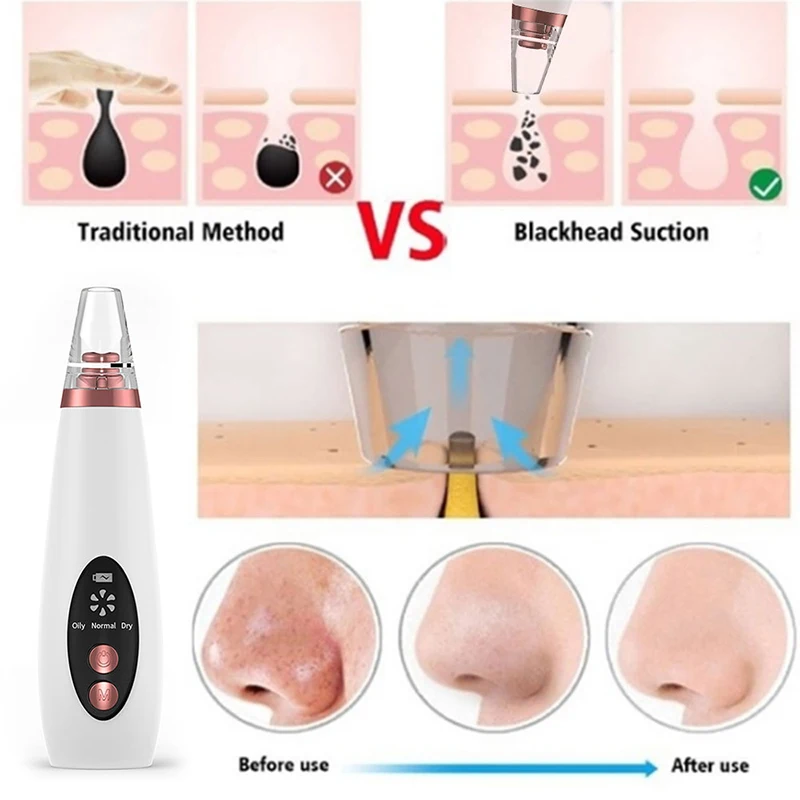 Best Blackhead Remover Vacuum 2021 Pore Cleaner Face Skin Care Best Blackhead Remover Vacuum 2021 Pore Cleaner Face Skin Care