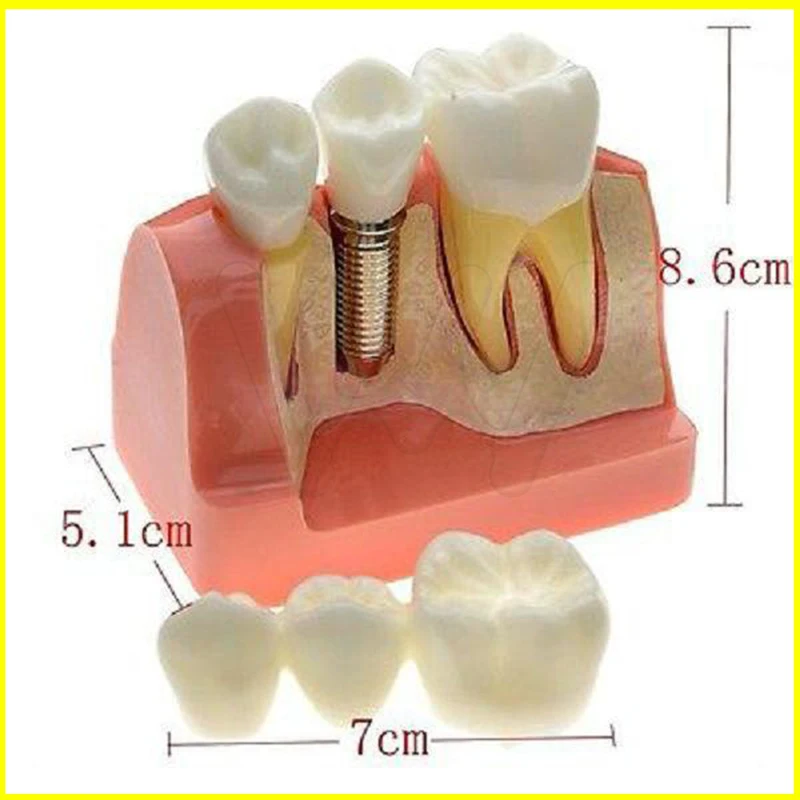 Dental Demonstration Teeth Model Implant Analysis Crown Bridge 
Dental Demonstration Teeth Model Implant Analysis Crown Bridge