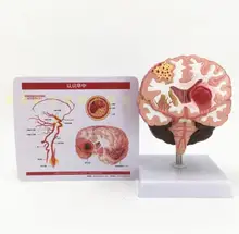 Human brain anatomy brain pathological disease brain pathological structure cerebral vascular disease brain model
Human brain anatomy brain pathological disease brain pathological structure cerebral vascular disease brain model