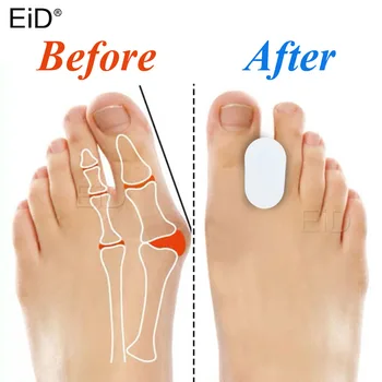 EiD 2Pcs Silicone Toe Separator Bunion Splint Hallux Valgus Orthosis Correction Overlapping Spreader Foot Protector Inserts
EiD 2Pcs Silicone Toe Separator Bunion Splint Hallux Valgus Orthosis Correction Overlapping Spreader Foot Protector Inserts