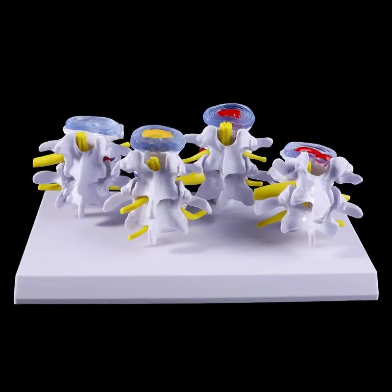 1 Set Human Lumbar Lesion Spine Statue Display Model Medical Teaching Learning Tool LX9A
1 Set Human Lumbar Lesion Spine Statue Display Model Medical Teaching Learning Tool LX9A