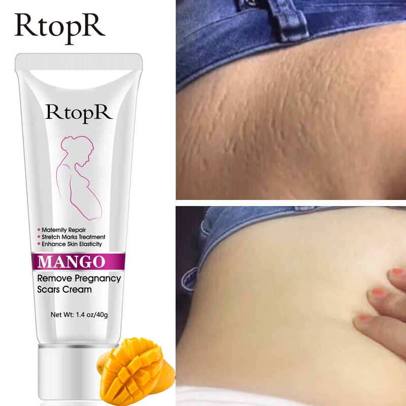 Mango Remove Pregnancy Scars Acne Cream Stretch Marks Treatment Maternity Repair Anti-Aging Anti-Winkles Firming Body Creams
Mango Remove Pregnancy Scars Acne Cream Stretch Marks Treatment Maternity Repair Anti-Aging Anti-Winkles Firming Body Creams