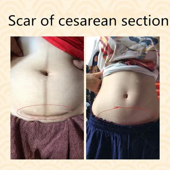 Remove scar, repair scar of caesarean section knife, desalt pregnancy mark, melanin, operation scar, scar removing cream sets
Remove scar, repair scar of caesarean section knife, desalt pregnancy mark, melanin, operation scar, scar removing cream sets