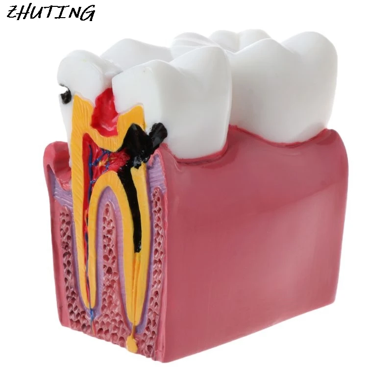6 Times Dental Caries Comparation Anatomy Teeth Model for Dental Anatomy Lab Teaching Studying Researching Tool
6 Times Dental Caries Comparation Anatomy Teeth Model for Dental Anatomy Lab Teaching Studying Researching Tool