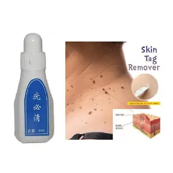 6ml Skin Tag Remover Chinese Medicine Body Warts Treatment Foot Corn Removal 12 Hours Remover Skin Tag Remover Foot Care
6ml Skin Tag Remover Chinese Medicine Body Warts Treatment Foot Corn Removal 12 Hours Remover Skin Tag Remover Foot Care