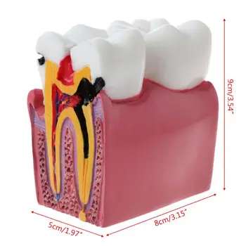 6 Times Dental Caries Comparation Anatomy Teeth Model for Dental Anatomy Lab Teaching Studying Researching Tool 
6 Times Dental Caries Comparation Anatomy Teeth Model for Dental Anatomy Lab Teaching Studying Researching Tool