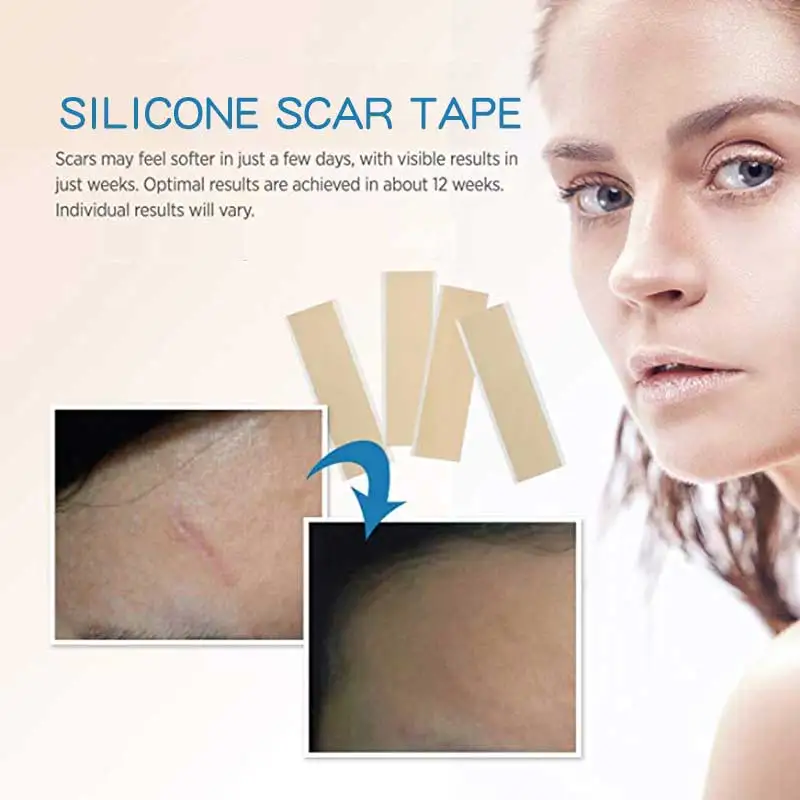 Silicone Scar Sheets Soften Flattens Scars Resulting from Surgery, Injury, Burns, Acne, C-section and more, Soft Silicone Tape
Silicone Scar Sheets Soften Flattens Scars Resulting from Surgery, Injury, Burns, Acne, C-section and more, Soft Silicone Tape