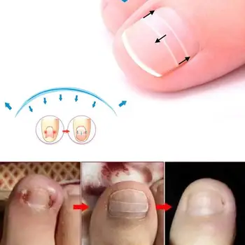 Toenail Ingrown Correction Tool Toe Nail Lifter Nail Glue Products Toenail Care Foot Pedicure Recover Straightening Pusher N9W7
Toenail Ingrown Correction Tool Toe Nail Lifter Nail Glue Products Toenail Care Foot Pedicure Recover Straightening Pusher N9W7
