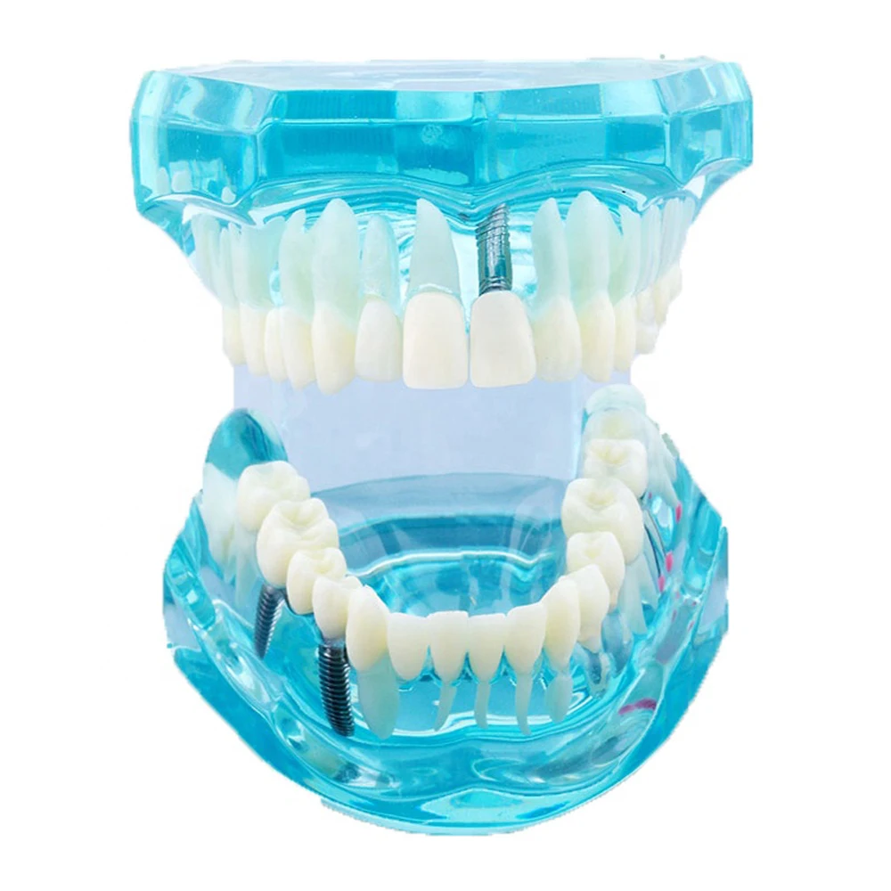 Фото Модель зубной имплантации с реставрационным мостом Корона | Отзывы и видеообзор (1005002934783819)
