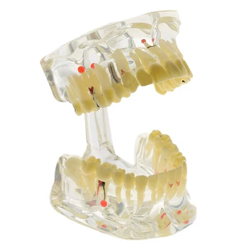 Implant Disease Teeth Model with Restoration Bridge Dentist for Science Disease Teaching Study
Implant Disease Teeth Model with Restoration Bridge Dentist for Science Disease Teaching Study