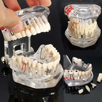 Hot Dental Implant Disease Teeth Model With Restoration Bridge Tooth Dentist For Medical Science Dental Disease Teaching Study
Hot Dental Implant Disease Teeth Model With Restoration Bridge Tooth Dentist For Medical Science Dental Disease Teaching Study