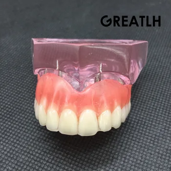 Dental Overdenture Superior with 4 Implants Demo Model Dental Teaching Study Demonstrate Model #6001 01 Dentalmall
Dental Overdenture Superior with 4 Implants Demo Model Dental Teaching Study Demonstrate Model #6001 01 Dentalmall