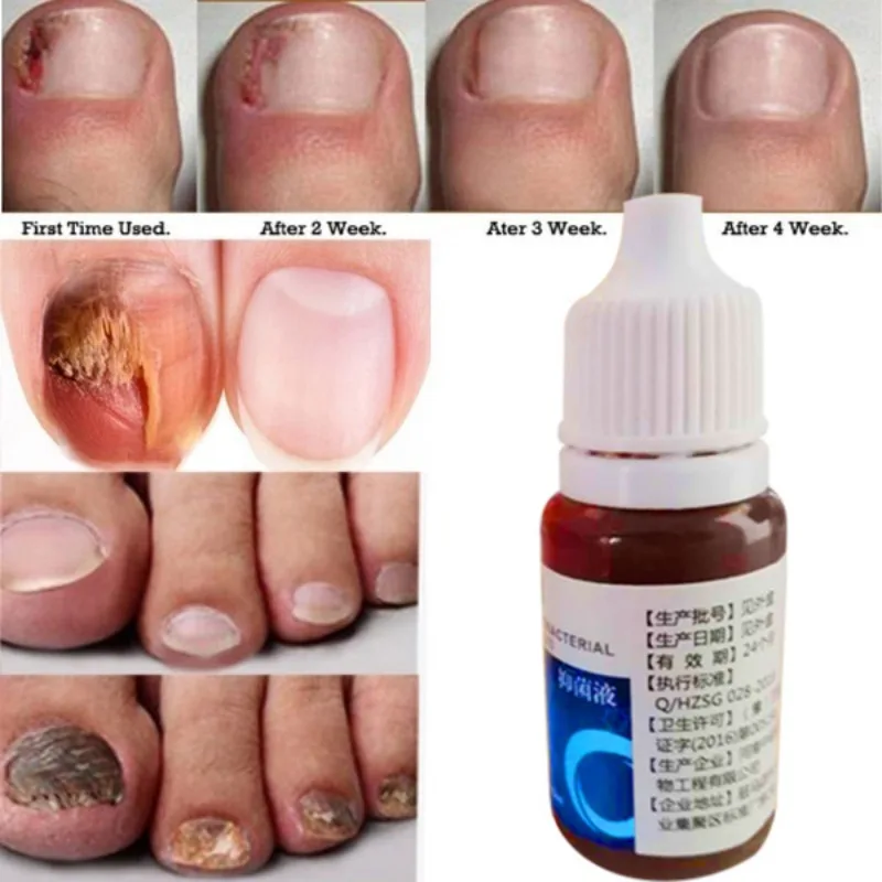 Nail Antifungal Liquid Disinfection Bacteriostatic Nail Repair Solution Nail Treatment
Nail Antifungal Liquid Disinfection Bacteriostatic Nail Repair Solution Nail Treatment