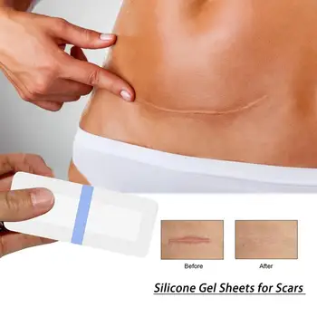 5pcs Efficient Caesarean Section Surgery Removal Scar Sheet Therapy Patch For Acne Trauma Burn Scar Skin Repair Beauty Stickers