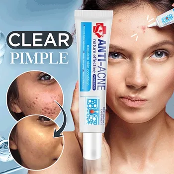 30g Acne Treatment Blackhead Remova Anti-Acne Cream Oil Control Shrink Pores Acne Scar Remove Face Care Whitening
30g Acne Treatment Blackhead Remova Anti-Acne Cream Oil Control Shrink Pores Acne Scar Remove Face Care Whitening