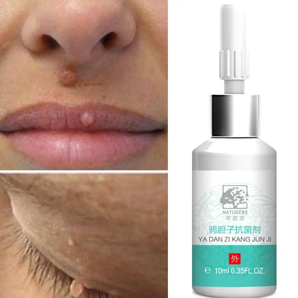 10ml Skin Tag Remover Anti bacterial Liquid Foot Corn Plantar Warts Thorn Removal Foot Calluses Anti Itching Musk Cream
10ml Skin Tag Remover Anti bacterial Liquid Foot Corn Plantar Warts Thorn Removal Foot Calluses Anti Itching Musk Cream