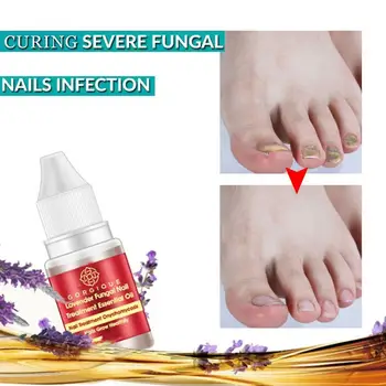 Lavender Fungus Nail Treatment Essential Oil Nail Nourishing Nails Grow Foot Brightening Promote Care Onychomycosis E9E1
Lavender Fungus Nail Treatment Essential Oil Nail Nourishing Nails Grow Foot Brightening Promote Care Onychomycosis E9E1