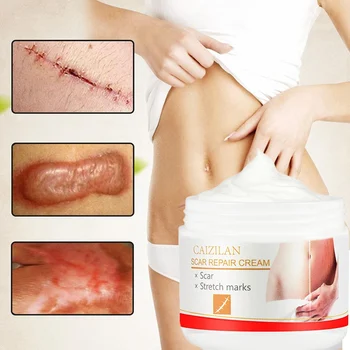 30g Acne Scar Stretch Marks Repair Cream Smoothing Scar Repair Cream Anti-Aging Firming Creams Removal Spots Blackhead
30g Acne Scar Stretch Marks Repair Cream Smoothing Scar Repair Cream Anti-Aging Firming Creams Removal Spots Blackhead