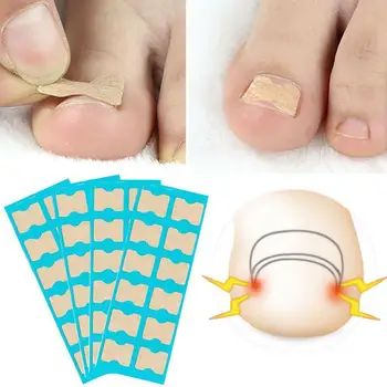 Ingrown Toenail Correction Sticker Paronychia Treatment Pedicure Foot Recover Care Toe Corrector Fixer Nail Tool
Ingrown Toenail Correction Sticker Paronychia Treatment Pedicure Foot Recover Care Toe Corrector Fixer Nail Tool