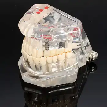 Dental Implant Disease Teeth Model With Restoration Bridge Tooth Dentist For Medical Science Dental Disease Teaching Study
Dental Implant Disease Teeth Model With Restoration Bridge Tooth Dentist For Medical Science Dental Disease Teaching Study
