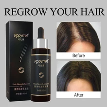 

60ml Hair Growth Essence Dense Hair Growth Serum for Men/Women Hair Loss Treatment Scalp Care Ginger Germinal Regrowth Hair Oils