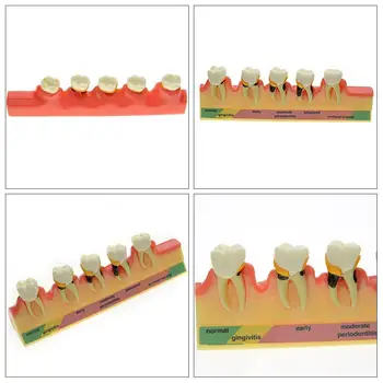 1PC Dental Model Pathological Classification Model Models Communication Dental Doctor-patient Model Z3J1
1PC Dental Model Pathological Classification Model Models Communication Dental Doctor-patient Model Z3J1