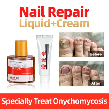 Onychomycosis Treatment Gel Toe Nails Impatiens Antibacterial Liquid,Fungal Nail Repair Liquid Dressing Pom For Fnger Sticker
Onychomycosis Treatment Gel Toe Nails Impatiens Antibacterial Liquid,Fungal Nail Repair Liquid Dressing Pom For Fnger Sticker