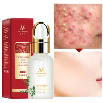 10ml Skin Repair Acne Essence Scar Removal Anti-wrinkles Oil Control Natural Ingredient Universal Brightening Serum Moisturizing
10ml Skin Repair Acne Essence Scar Removal Anti-wrinkles Oil Control Natural Ingredient Universal Brightening Serum Moisturizing