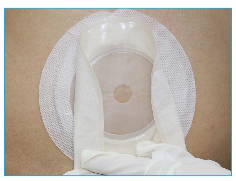 40 pcs/lot Anti-curl up Colostomy Fix Tape Anti-shedding Non-woven Spunlaced tapes Ostomy Bag Assistance for Stoma
40 pcs/lot Anti-curl up Colostomy Fix Tape Anti-shedding Non-woven Spunlaced tapes Ostomy Bag Assistance for Stoma