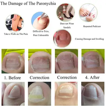 Ingrown Toenail Correction Tool Set Ingrown Toe Nail Clip Foot Straightening Care Brace Elastic Pedicure Patch Corrector Bu P4N7
Ingrown Toenail Correction Tool Set Ingrown Toe Nail Clip Foot Straightening Care Brace Elastic Pedicure Patch Corrector Bu P4N7