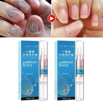 Toenail Nail-Treatment-Pen Treat Onychomycosis Paronychia Anti-fungal Nail Infection Treatment Nail Care Treatment 
Toenail Nail-Treatment-Pen Treat Onychomycosis Paronychia Anti-fungal Nail Infection Treatment Nail Care Treatment