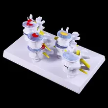 1 Set Human Lumbar Lesion Spine Statue Display Model Medical Teaching Learning Tool
1 Set Human Lumbar Lesion Spine Statue Display Model Medical Teaching Learning Tool
