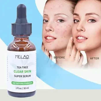 Tree Oil Acne Treatment Scar Repair Oil Control Face Skin Care Serum Smooth Skin 30ml
Tree Oil Acne Treatment Scar Repair Oil Control Face Skin Care Serum Smooth Skin 30ml