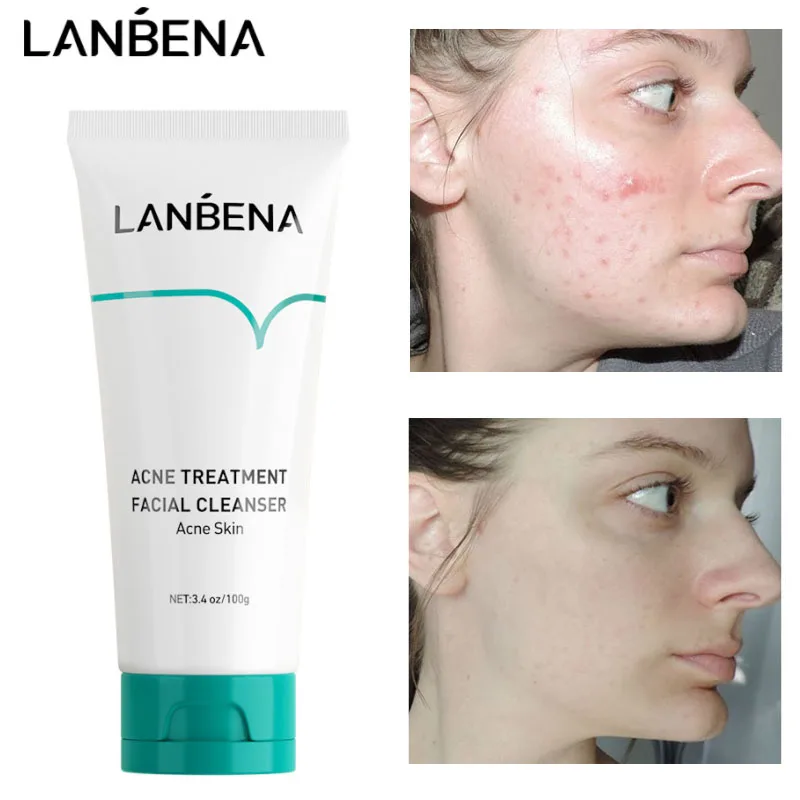 LANBENA Acne Treatment Facial Cleanser Acne Removal Oil Control Shrinking Pores Gentle Clean Pimple Blackhead Removal Skin Care
LANBENA Acne Treatment Facial Cleanser Acne Removal Oil Control Shrinking Pores Gentle Clean Pimple Blackhead Removal Skin Care