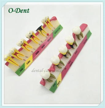 Dental teeth model endo caries decayed tooth decay dental caries root canal model classify assortment Model decoration
Dental teeth model endo caries decayed tooth decay dental caries root canal model classify assortment Model decoration