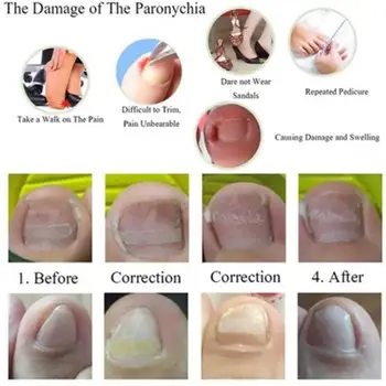 Toenail Ingrown Correction Tool Set Toe Nail Lifter Glue Straightening Patch Recover Pusher Nail Nail Care Toenail Foot Ped R0Z5
Toenail Ingrown Correction Tool Set Toe Nail Lifter Glue Straightening Patch Recover Pusher Nail Nail Care Toenail Foot Ped R0Z5