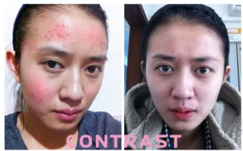 Facial allergic skin anti-sun repair cream red blood sensitive skin special skin care products 30G
Facial allergic skin anti-sun repair cream red blood sensitive skin special skin care products 30G